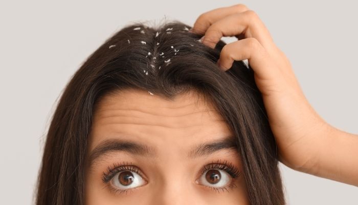 como evitar la caspa del cabello